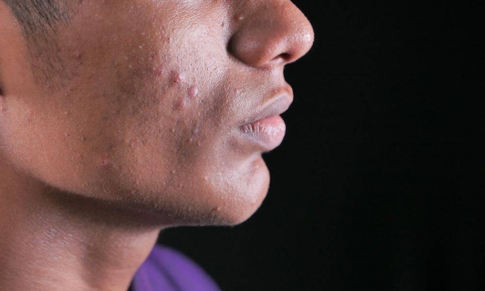 6 Easy Ways of Getting Rid of Pimples without Popping it